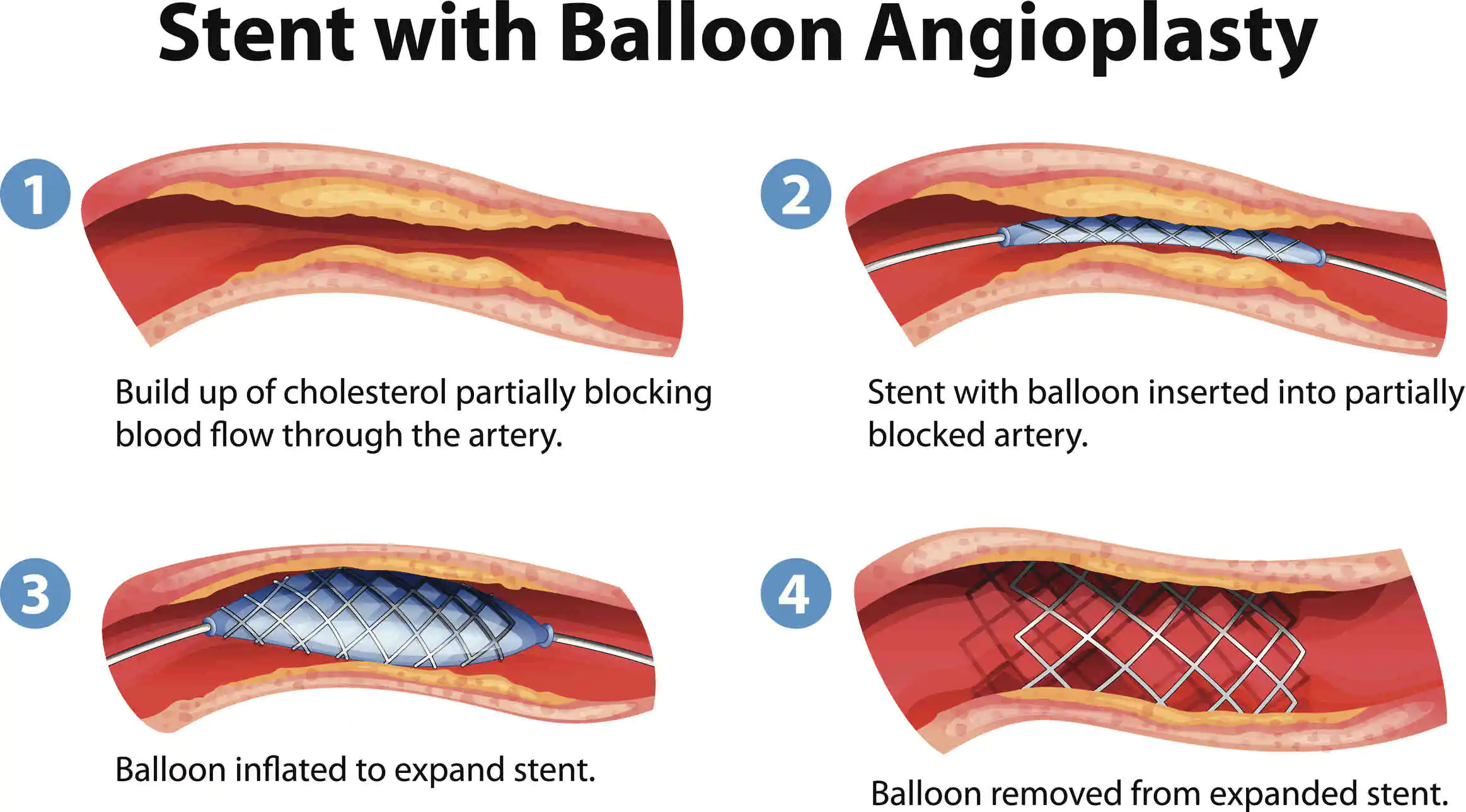 Stent angioplasty procedure